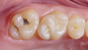 Fileira de dentes antes do tratamento