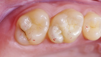 Fileira de dentes após o tratamento