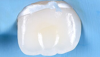 Dente polido e brilhante, sem manchas brancas
