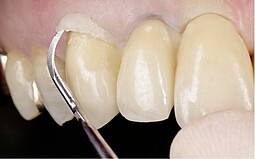 Aplicação da massa no dente