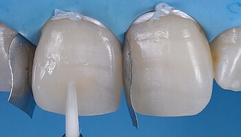 Massa é aplicada no dente