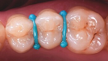 Massa entre os dentes