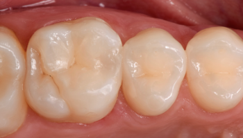 Visualização do dente