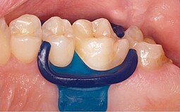 Parte azul entre os dentes